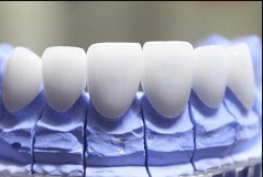 Khắc phục răng thưa nên sử dụng bọc răng sứ hay không?