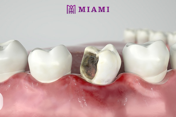 Sâu răng không chỉ gây đau nhức mà còn gây ra những biến chứng nguy hiểm thậm chí là mất răng
