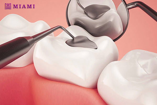 Trám răng thẩm mỹ là biện pháp phục hình răng được khá nhiều người lựa chọn