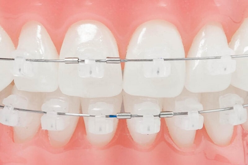 Phương pháp niềng răng thẩm mỹ - Phương pháp chỉnh nha số 1 hiện nay