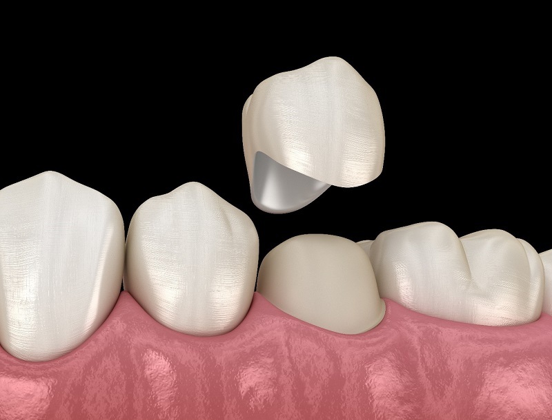 Răng chết tủy, bọc răng sứ để bảo vệ răng tại MIAMI