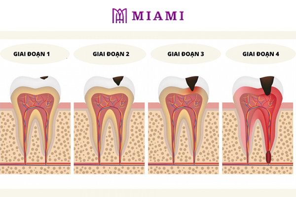 4 Giai đoạn sâu răng cần chú ý