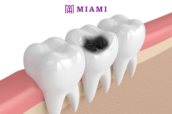Một số phương pháp điều trị dứt điểm sâu răng