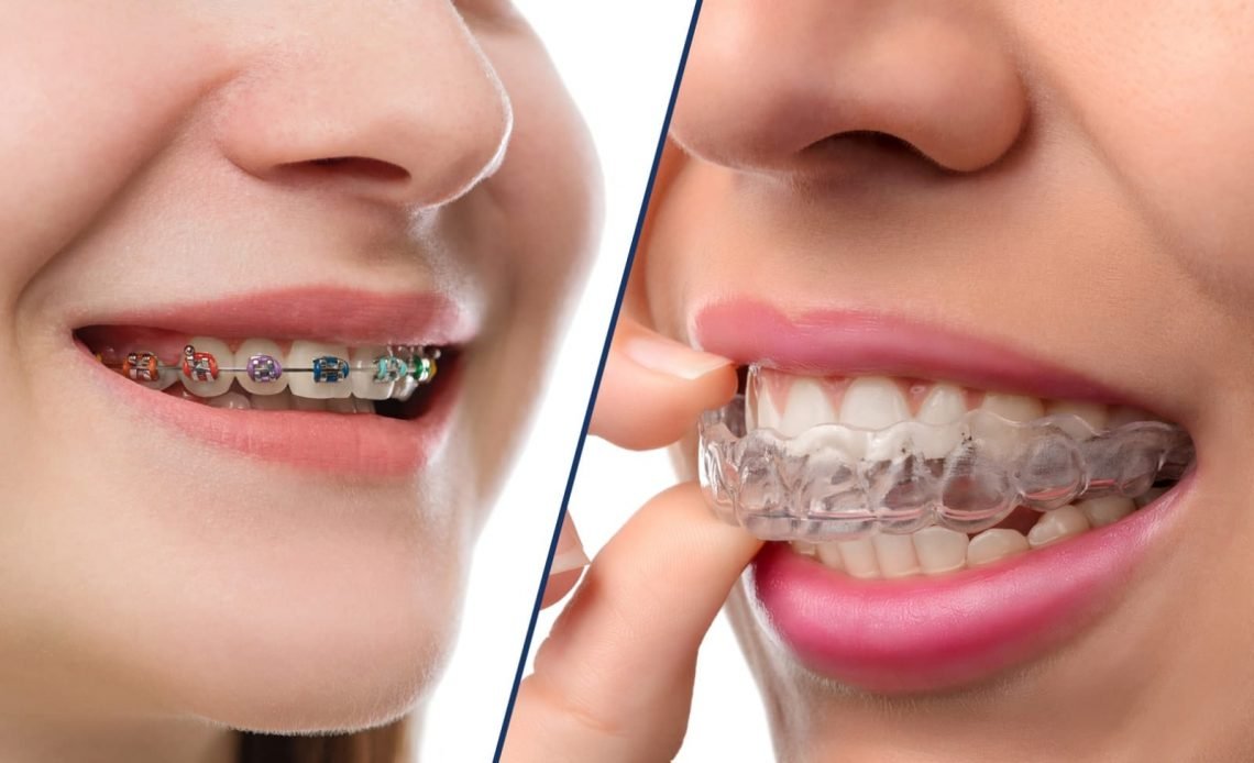 Niềng răng - Phương pháp an toàn nhất khắc phục tình trạng răng không đều