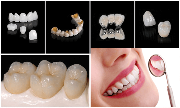 Cầu răng sứ thẩm mỹ từ kim loại