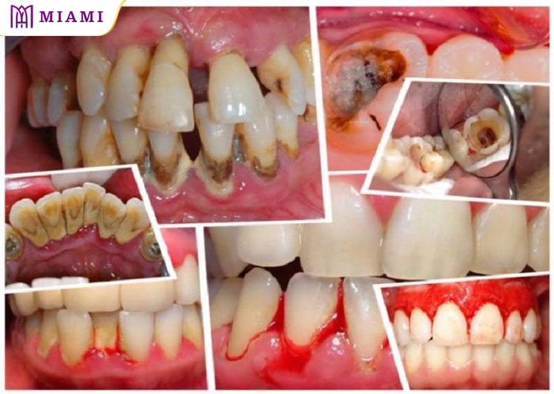 Những tác hại khó lường mà răng khôn gây ra