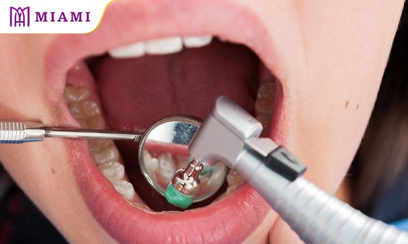 Toàn bộ quy trình lấy cao răng chỉ mất khoảng 30 phút của bạn
