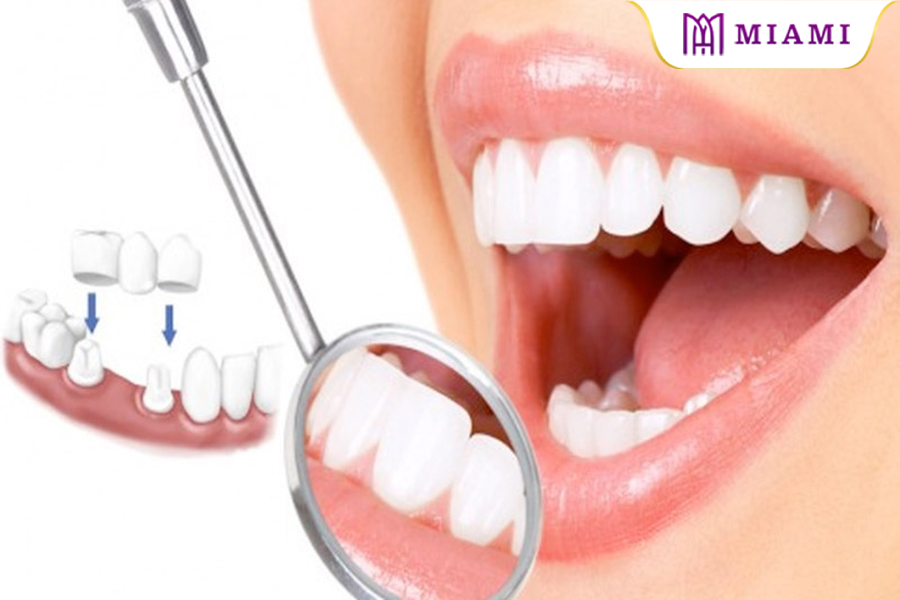 Răng sứ HT MAX là loại răng sứ với độ trong, độ bền và khả năng chịu lực vượt trội